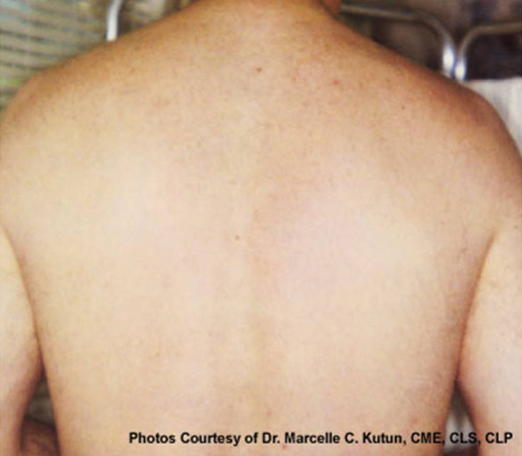 man's hairless back after laser hair removal