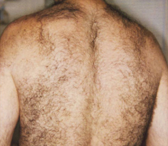 man's hairy back before laser hair removal