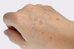 age spots on a hand