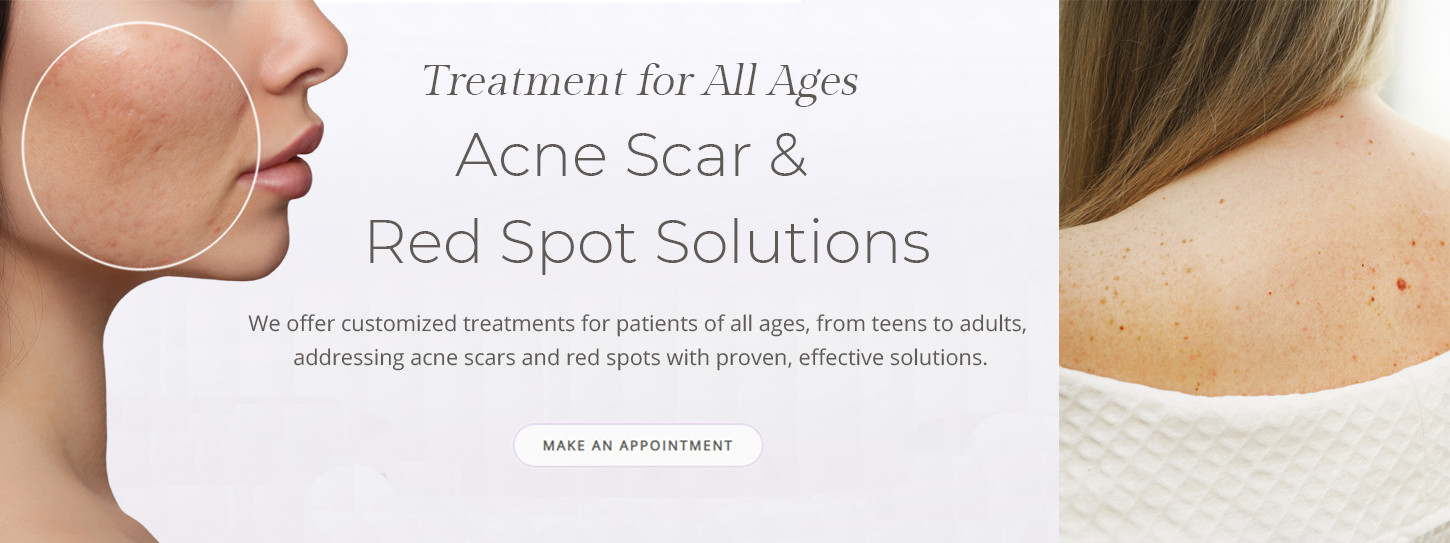 Acne Scar & Red Spot solutions. customized treatements for patients of all ages from teens to adults addressing acne scars and red spots with proven effective solution