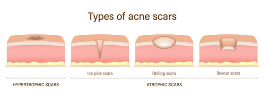 4 types of acne scars